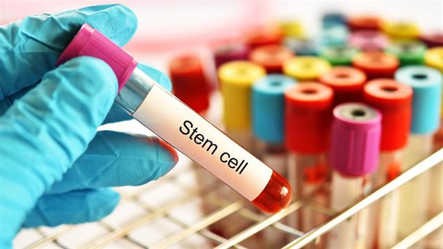 Μεταμόσχευση βλαστοκυττάρων είναι πιθανό να αναστρέψει την αναπηρία σε ορισμένους ανθρώπους με πολλαπλή σκλήρυνση [μελέτη]