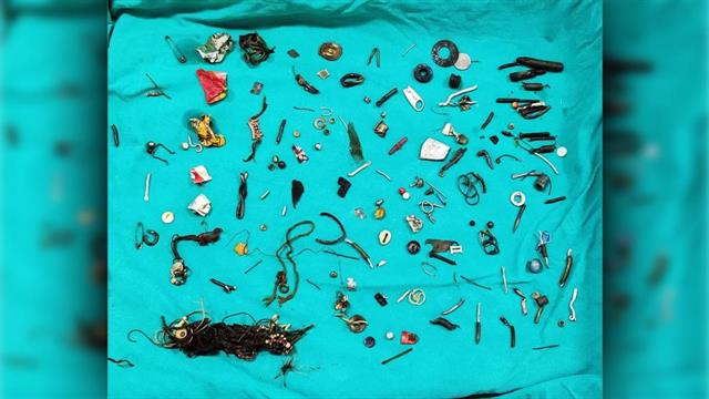 Γιατροί στην Ινδία εντόπισαν 60 αντικείμενα στο στομάχι ασθενούς!