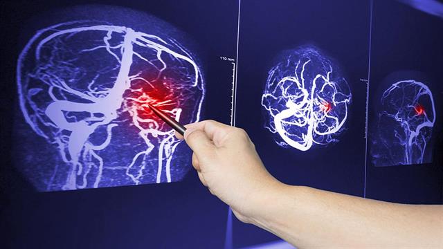 H Covid αυξάνει τον κίνδυνο καρδιακής προσβολής και εγκεφαλικού επεισοδίου [μελέτη]
