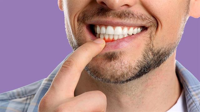 Φάρμακο για τον διαβήτη στη μάχη κατά της περιοδοντίτιδας [μελέτη]