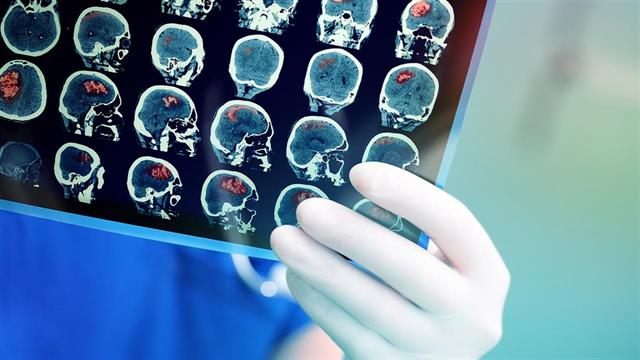 Η άμεση θεραπεία στην οξεία φάση του εγκεφαλικού είναι ζωτικής σημασίας