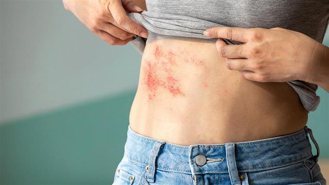 Η σχέση του έρπητα ζωστήρα με την ανεμοβλογιά - Ποιους απειλεί περισσότερο