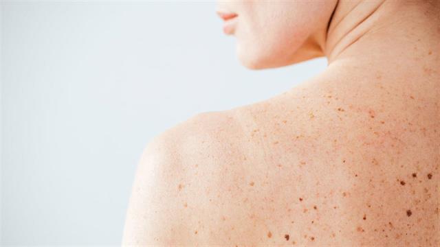 Τεχνητή νοημοσύνη: 100% επιτυχία στη διάγνωση μελανώματος [μελέτη]