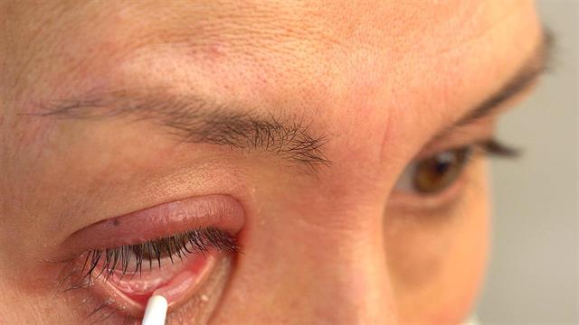 Ποιες παρτίδες γνωστής οφθαλμικής αλοιφής ανακαλούνται από τον ΕΟΦ