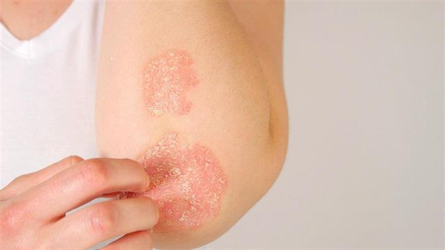 29 Οκτωβρίου Παγκόσμια Ημέρα Ψωρίασης: Πρόσβαση για όλους