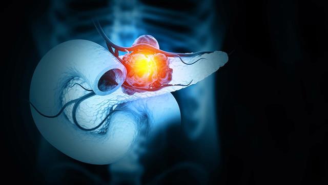 Έρευνα συνδέει άμεσα την υψηλή ινσουλίνη με τον καρκίνο στο πάγκρεας