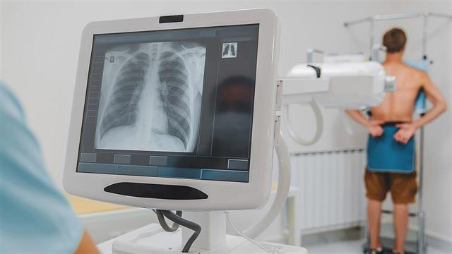 Κάπνισμα και άλλοι τρεις παράγοντες κινδύνου για καρκίνο του πνεύμονα