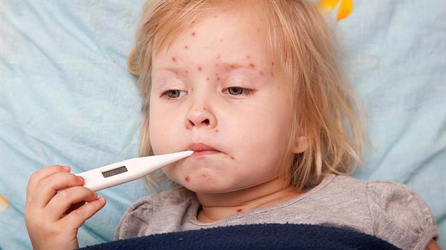 ECDC: Κρούσματα ιλαράς σε 19 ευρωπαϊκές χώρες - Πώς μεταδίδεται ο ιός