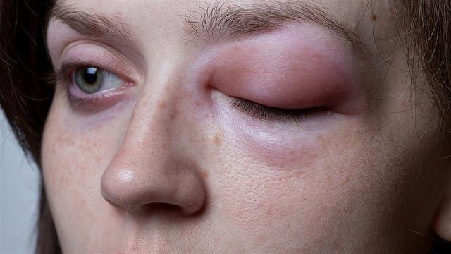 Αυστριακή μελέτη επιβεβαιώνει τη δράση φαρμάκου κατά του αγγειοοιδήματος