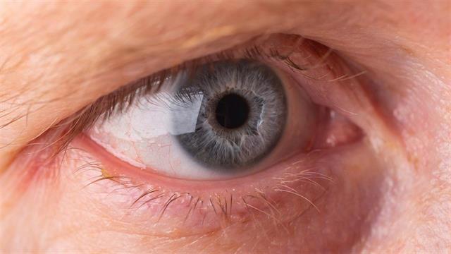 Πώς αποκαθίστανται τα πεσμένα βλέφαρα