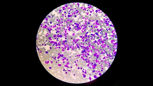 Υποσχόμενο φάνηκε φάρμακο για το πολλαπλούν μυέλωμα σε κλινική δοκιμή τελικού σταδίου