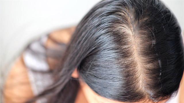 Γιατί χάνω τα μαλλιά μου;