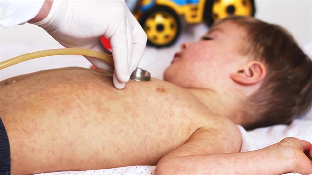 Συναγερμός λόγω εξάπλωσης ιλαράς στη Ρουμανία- κηρύχτηκε επιδημία