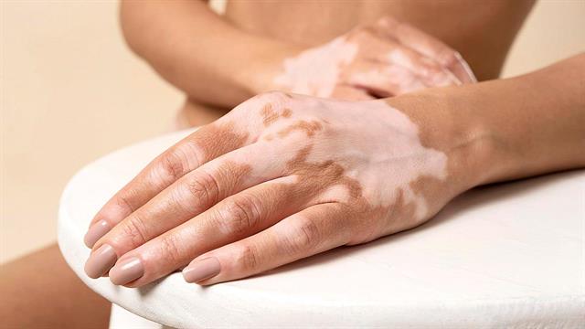 Λεύκη: Νέα κρέμα για την αντιμετώπισή της