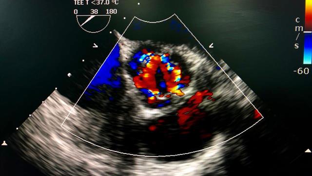 Διαδερμική αντικατάσταση Αορτικής Βαλβίδας: H ενηλικίωση της θεραπείας που καταργεί το χειρουργείο