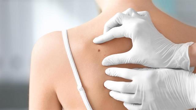 Moderna: Το εμβόλιό της κατά του μελανώματος θα μπορούσε να κυκλοφορήσει εντός 2 ετών