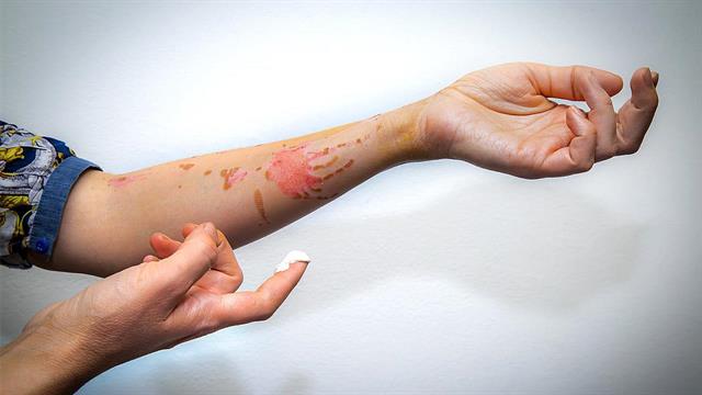 Το Γενικό Νοσοκομείο Γεώργιος Παπανικολάου στηρίζει την Πανελλήνια Ημέρα Πρόληψης Εγκαυμάτων