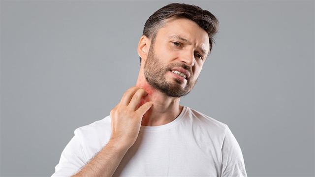 Αποτελεσματικός ο βελονισμός σε ασθενείς με χρόνια κνίδωση [μελέτη]