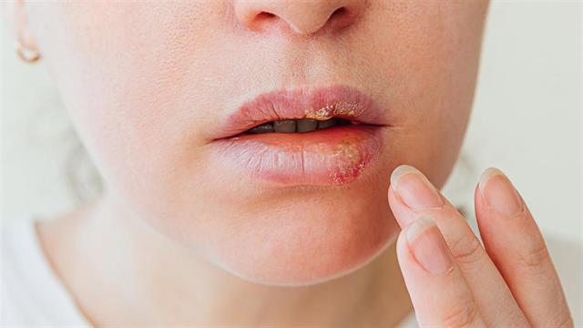 Το στοματικό διάλυμα μειώνει τη μολυσματικότητα του επιχείλιου έρπητα [μελέτη]