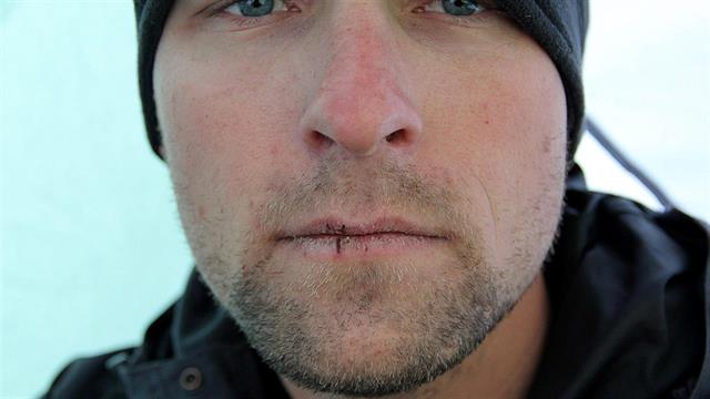 Ποια δερματικά προβλήματα μπορεί να προκύψουν τον χειμώνα