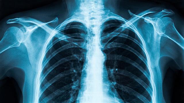 Νέο εργαλείο τεχνητής νοημοσύνης εντοπίζει με ακρίβεια άνω του 98% την COVID-19 από ακτινογραφίες θώρακος