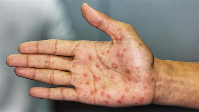 Ο FDA θα εισαγάγει φάρμακο για τη σύφιλη από τη Γαλλία λόγω έλλειψης