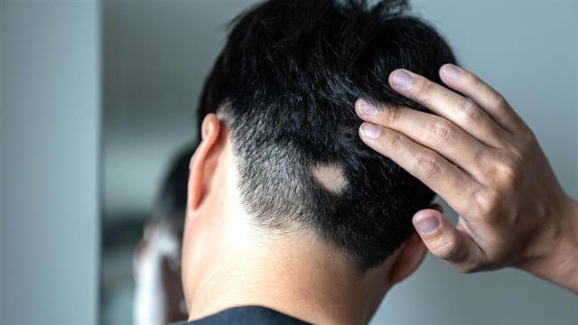 Συσχέτιση αυτοάνοσων νοσημάτων, όπως της γυροειδούς αλωπεκίας, με τη νόσηση από COVID-19