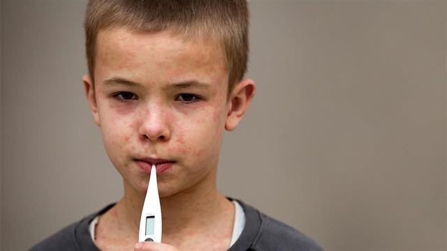 ΠΟΥ: 30 φορές αυξήθηκαν τα κρούσματα ιλαράς το 2023 στην Ευρώπη