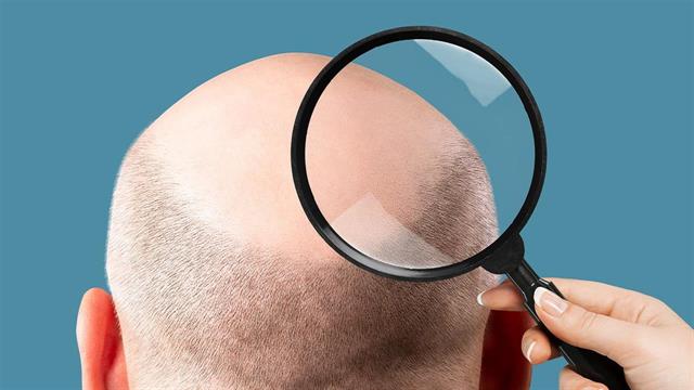 Τριχόπτωση: Ένοχο και το κάπνισμα;