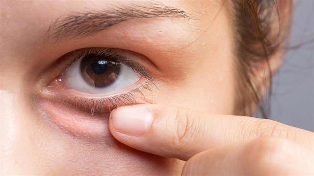 Πρήξιμο γύρω από τα μάτια: Τι μπορεί να σημαίνει;