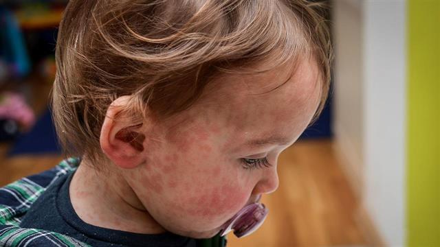 Ιλαρά: Η πιο μολυσματική ασθένεια που έχει γνωρίσει η Επιστήμη - Ξεπερνά και την CoViD