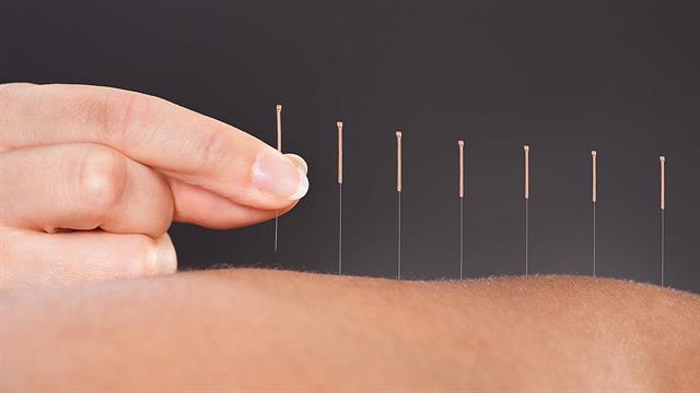 Ο βελονισμός μειώνει τον κίνδυνο εγκεφαλικού σε άτομα με ρευματοειδή αρθρίτιδα [μελέτη]