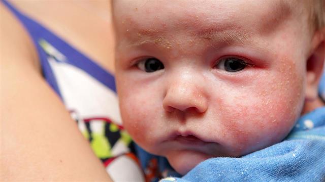 Ατοπική δερματίτιδα: Από τι άλλο κινδυνεύουν οι μικροί ασθενείς
