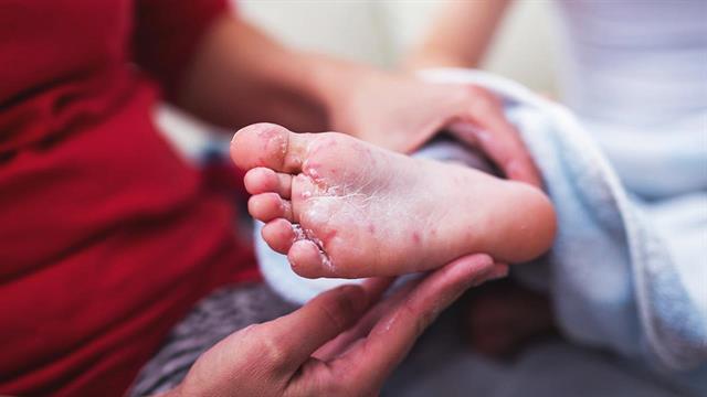 ECDC: Θα συνεχιστεί η αύξηση κρουσμάτων ιλαράς - Τι αναμένεται τους επόμενους μήνες