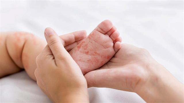 Κομισιόν για ιλαρά: Να εμβολιαστεί τουλάχιστον το 95% του πληθυσμού