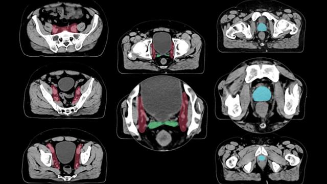 Λογισμικό με τεχνητή νοημοσύνη στο Ακτινοθεραπευτικό του Θεαγένειου