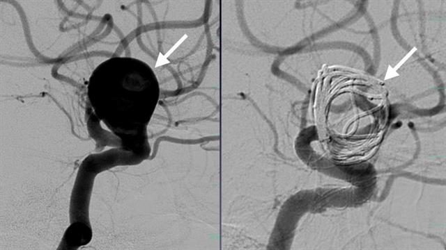 Ευαγγελισμός:  Πώς έσωσαν 46χρονη μητέρα από εγκεφαλική αιμορραγία