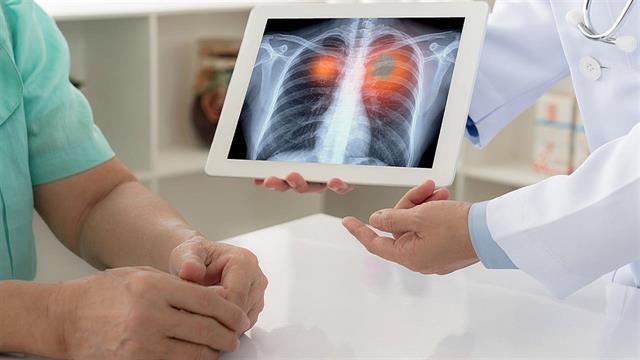 Πανδημία κορωνοϊού: καθυστερήσεις στη διάγνωση και θεραπεία του πνευμονολογικού καρκίνου [μελέτη]