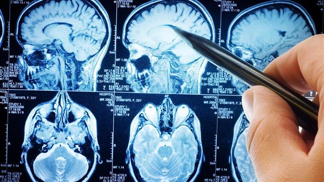 Αντιδιαβητικά φάρμακα μειώνουν τον κίνδυνο όγκων στον εγκέφαλο [μελέτη]