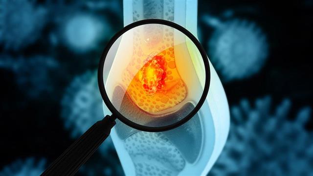 Οστεοσάρκωμα: Οι καθυστερήσεις στη θεραπεία αυξάνουν τον κίνδυνο θανάτου [μελέτη]