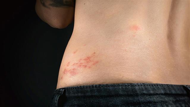 Διεθνής Έρευνα της GSK για τον έρπητα ζωστήρα