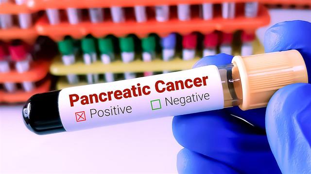 Εγκαιρη διάγνωση καρκίνου στο πάγκρεας με υγρή βιοψία