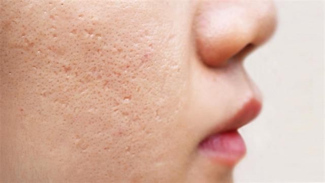 Ουλές ακμής: Πώς μπορώ να τις αποφύγω