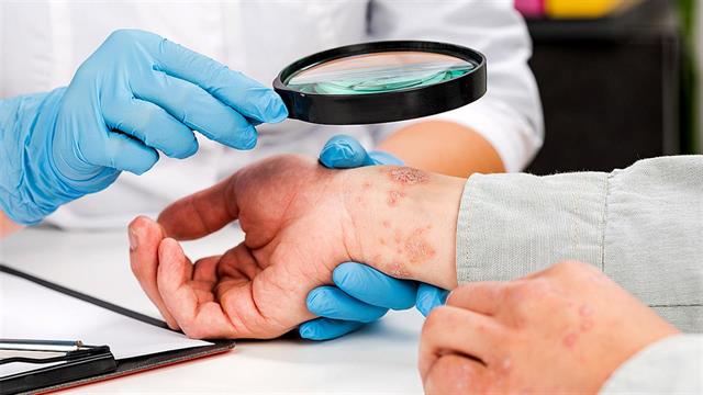 Μελέτη μητρώου: Υψηλός αριθμός συννοσηροτήτων στην ψωρίαση