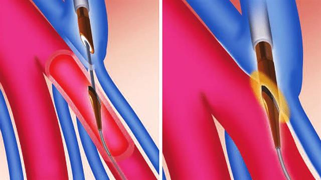 Ερρίκος Ντυνάν: Πρωτοποριακή, μη επεμβατική τεχνική φίστουλας για νεφροπαθείς