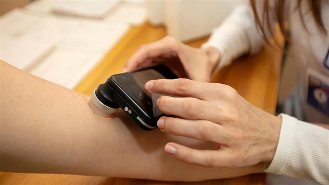 Εφαρμογή εντοπίζει επικίνδυνες ελιές στο δέρμα [μελέτη]