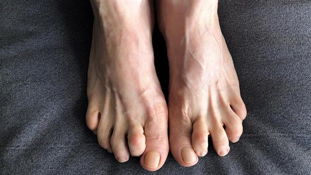 Προβλήματα των ποδιών που εμφανίζονται όσο μεγαλώνουμε