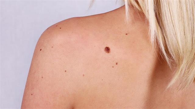 Μη επεμβατική εικονική βιοψία σαρώνει το δέρμα για καρκινικά κύτταρα