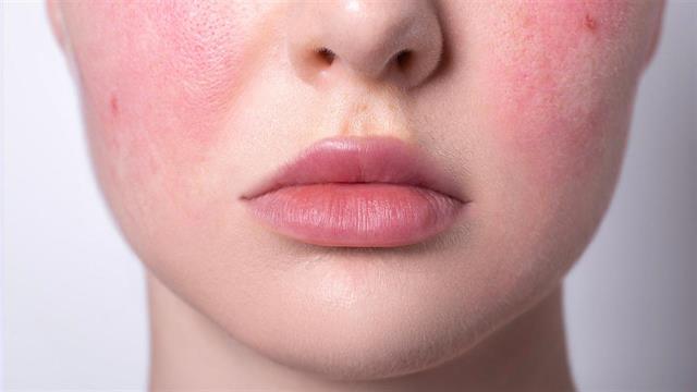 Ροδόχρους ακμή: Συμβουλές για τη διαχείριση εξάρσεων