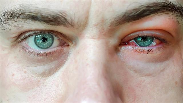 Μύθοι και αλήθειες για την επιπεφυκίτιδα